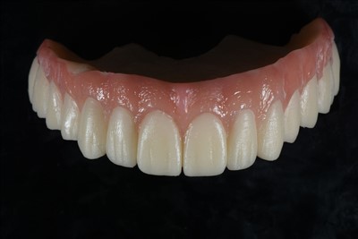 Akrüülvaigust ajutine kroon